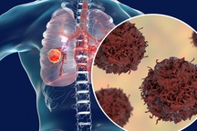 Phát hiện ung thư giai đoạn cuối ở tuổi 40, dù thường xuyên tập thể dục