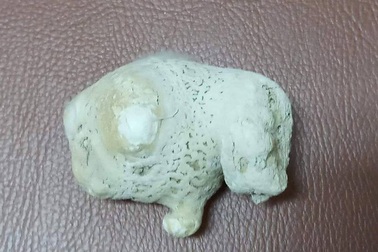 Viên sỏi “khủng” nằm trong thận của bệnh nhân bị thận móng ngựa