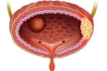 Phát hiện u bàng quang, có phải ung thư không?