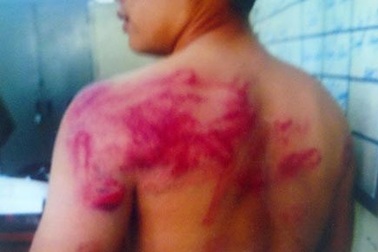 Dân tố bị công an đánh bầm người