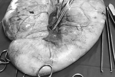 Lào Cai: Mổ thành công u nang buồng trứng nặng gần 6 kg