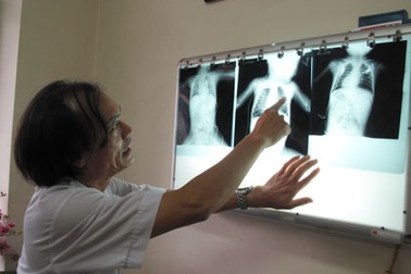 Cứu sống bé 1 tuổi tím đen, hôn mê vì hóc thạch