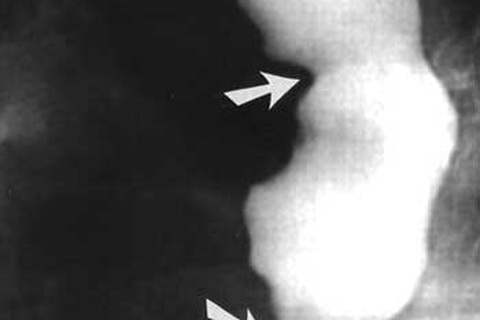 Cách phòng chống các loại tia phóng xạ 