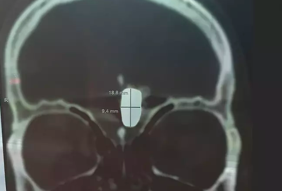 Ăn mừng 10 năm sống bình thường với một viên đạn trong não - 2 Ăn mừng 10 năm sống bình thường với một viên đạn trong não - 2