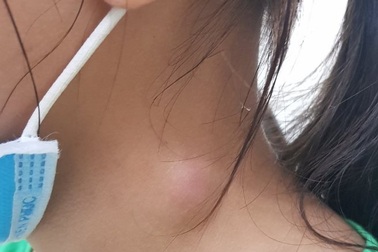 Mắc xương cá điều trị theo phương pháp dân gian, bé gái bị sưng vùng cổ