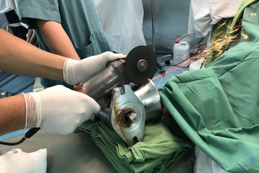 Bác sĩ dùng cưa sắt giải cứu bàn tay bị máy xay thịt "nuốt chửng"