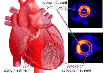 Thiếu máu cơ tim nên ăn gì để giảm đau thắt ngực, tốt cho tim