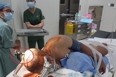 Nam thanh niên nhập viện với chùm chìa khóa cắm trên đỉnh đầu