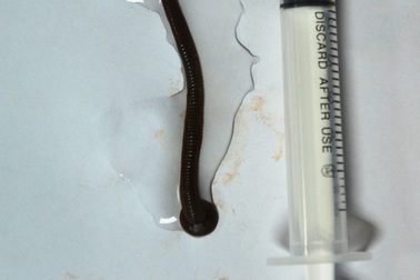 Gắp con đỉa dài 7 cm sống trong đường thở gần 2 tháng