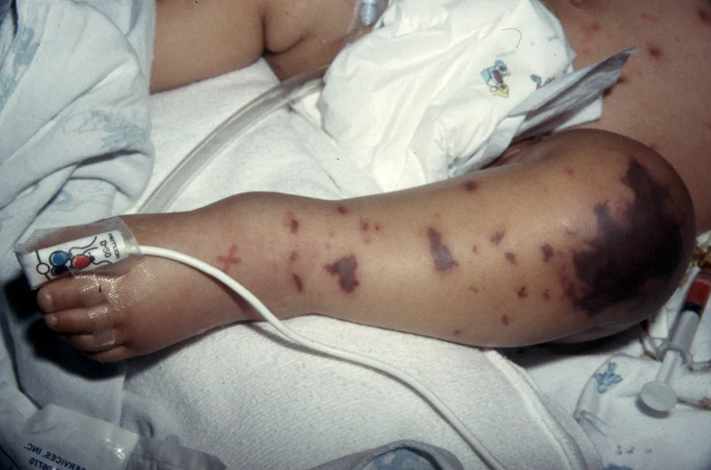 Bé gái ở Tây Ninh nguy kịch do não mô cầu nhóm B chưa tiêm vaccine - 1 Bé gái ở Tây Ninh nguy kịch do não mô cầu nhóm B chưa tiêm vaccine - 1