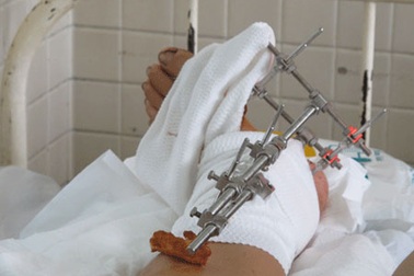 Máy cắt cỏ chém rớt bàn chân một phụ nữ