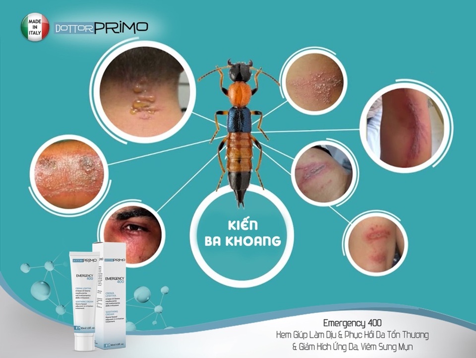 Cách xử lý vết thương do kiến ba khoang gây ra hiệu quả - 4 Cách xử lý vết thương do kiến ba khoang gây ra hiệu quả - 4