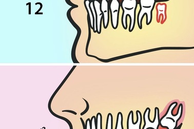 Vì sao nên nhổ răng khôn trước 25 tuổi?
