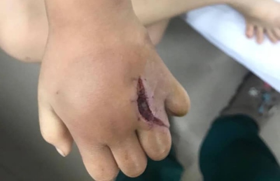 Bé gái 4 tuổi bị khỉ nhà hàng xóm cào rách tay, chảy mủ - 1