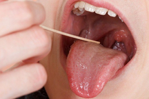 Những triệu chứng cần nghĩ ngay đến ung thư lưỡi