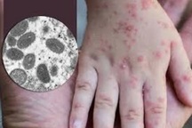 Bất ngờ ca nghi mắc bệnh đậu mùa khỉ ở Đà Nẵng: Là bệnh tay chân miệng
