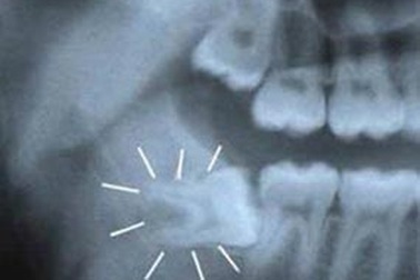 Đau khổ như mọc răng khôn 