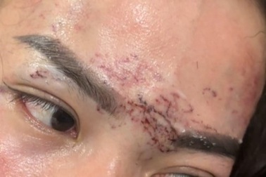 Vụ xăm lên mặt nghi do ghen tuông ở Cà Mau: Khởi tố 2 người phụ nữ