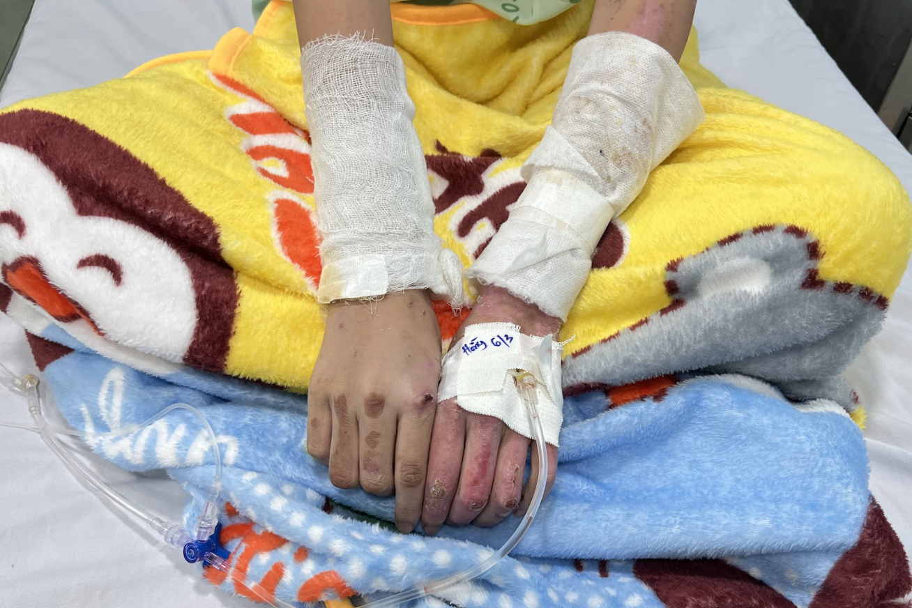 Flickan var svart när hon lades in på sjukhuset, hennes föräldrar brändes också allvarligt i branden i Ho Chi Minh-staden - 4 Bé gái đen kịt khi vào viện, cha mẹ cũng bỏng nặng trong vụ cháy ở TPHCM - 4