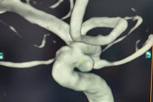 Phình mạch máu não: có thể chữa khỏi bằng can thiệp nội mạch