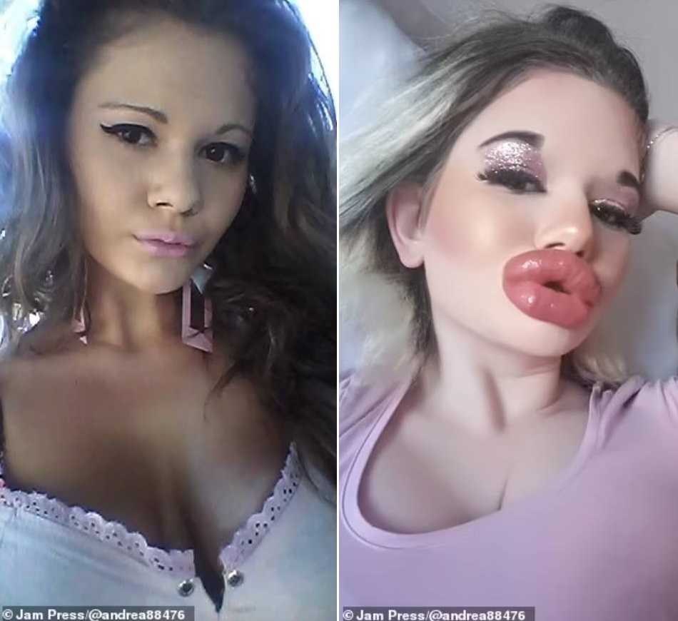 Cô gái bơm môi lần thứ 27 vì muốn trông giống... búp bê - 2