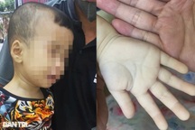 Mỗi ngày ăn 2 bữa cháo dinh dưỡng, bé trai tái xanh da, máu loãng như nước