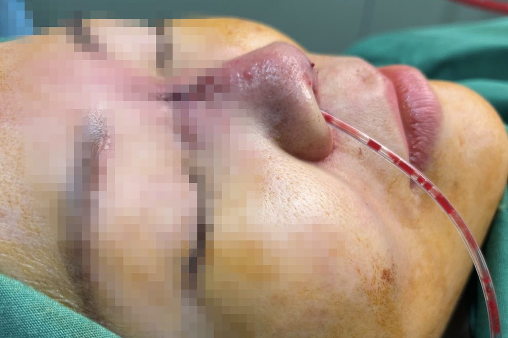 Thầy phán mũi thấp, vận nghèo rồi... sửa mũi cho khách, gây tai biến nặng - 2 Thầy phán mũi thấp, vận nghèo rồi... sửa mũi cho khách, gây tai biến nặng - 2