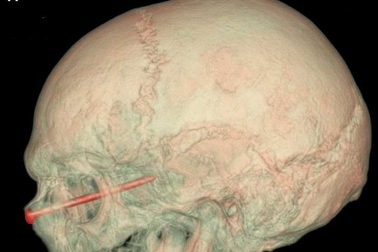 Bị đinh vít xuyên vào mắt vẫn bình an vô sự