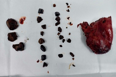 Đau bụng dữ dội vì túi mật chứa gần 50 viên sỏi