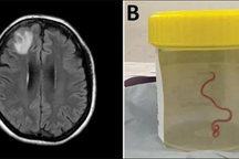 Sinh vật dài 8cm sống trong não người phụ nữ