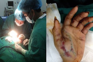 Sơ cứu thế nào cho người bị tai nạn do pháo nổ?