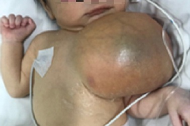 Bé trai chào đời mang theo khối u khổng lồ trên ngực