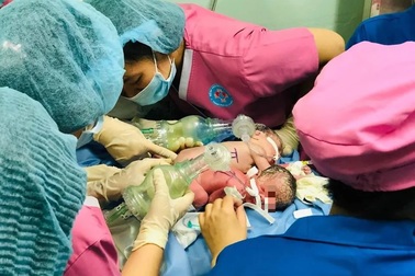 Hai bé gái sơ sinh dính nhau chung một hậu môn