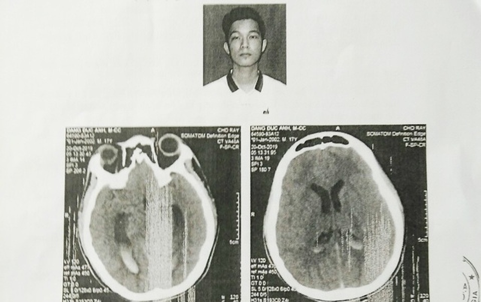 Vụ nam sinh bị đánh chấn thương não: Công an lý giải nguyên nhân chậm trễ - 1 Vụ nam sinh bị đánh chấn thương não: Công an lý giải nguyên nhân chậm trễ - 1