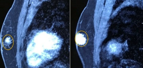 Người đàn ông mắc căn bệnh tưởng chỉ có ở phụ nữ - 1