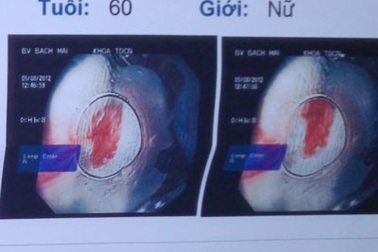Suýt chết vì chữa hóc xương cá bằng mẹo
