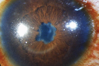 Căn bệnh hiểm khiến mắt người phụ nữ có màu vàng và nâu đen, nguy cơ mù lòa