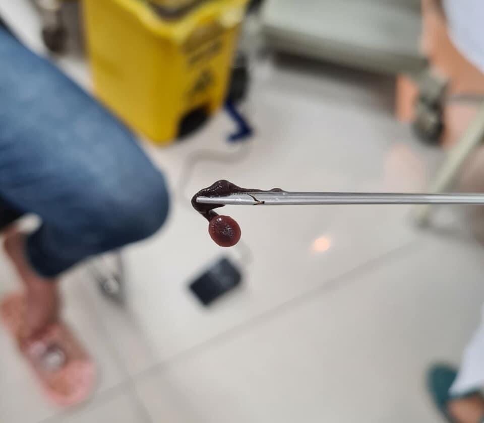 Đỉa rừng dài 3 cm ký sinh trong hốc mũi người phụ nữ 44 tuổi - 1 Đỉa rừng dài 3 cm ký sinh trong hốc mũi người phụ nữ 44 tuổi - 1