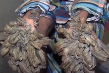 Gian nan hành trình chữa bệnh của “người cây”