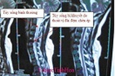 Đau vai gáy - căn bệnh không nên chủ quan