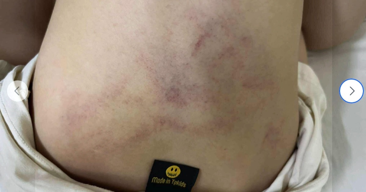 Vụ trẻ nghi bị giáo viên mầm non bạo hành: Công an vào cuộc xác minh