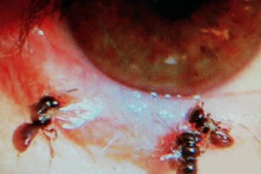 Ong ký sinh trong mắt người, say sưa hút... nước mắt