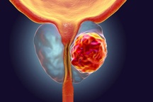 Dấu hiệu sớm của ung thư tuyến tiền liệt