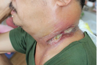 Suýt mất mạng vì đắp thuốc nam chữa u cổ