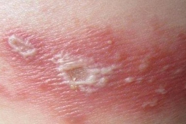 Nỗi ám ảnh "cơn đau thấu xương" của những bệnh nhân zona thần kinh