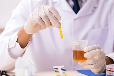 Xét nghiệm nước tiểu tại nhà phát hiện sớm ung thư tiền liệt tuyến