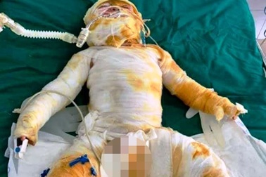 Vụ cháy phòng ngủ khiến cả gia đình bị bỏng: Hai bố con tử vong