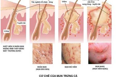 Trị mụn trứng cá: Bắt đầu từ nguyên nhân