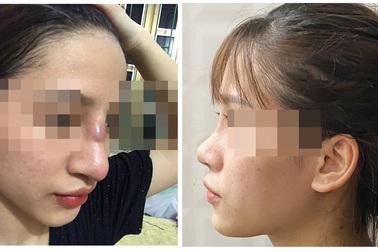 Nữ sinh 19 tuổi suýt thủng mũi sau khi làm đẹp tại spa