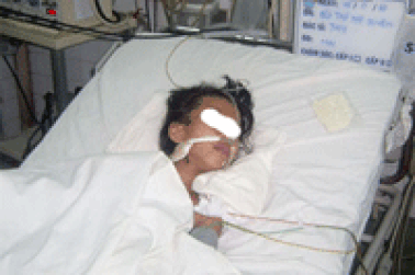 Cứu sống một trường hợp bị nhược cơ nặng